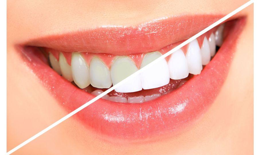 Blanqueamiento dental: mitos, riesgos y resultados reales