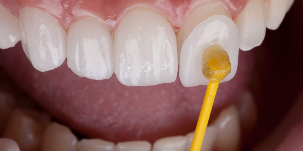 Carillas dentales: ventajas, tipos y cuidados posteriores